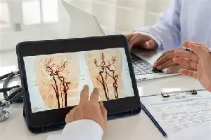 Strategi Nasional Atasi Stroke: Perkuat Skrining Dini dan Akselerasi Fasilitas Medis