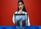Inovasi TBScreen.AI: Teknologi AI UGM Sukses Deteksi TBC dengan Akurasi Tinggi di Lima Faskes