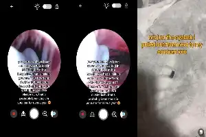 Keluhan Migrain Berkepanjangan, Seorang Wanita Temukan Benda Asing di Dalam Telinga