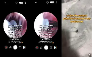 Keluhan Migrain Berkepanjangan, Seorang Wanita Temukan Benda Asing di Dalam Telinga
