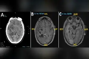 Diagnosis Keliru: Larva Cacing Pita di Otak Sempat Dikira Tumor Ganas