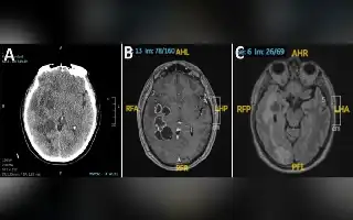 Diagnosis Keliru: Larva Cacing Pita di Otak Sempat Dikira Tumor Ganas