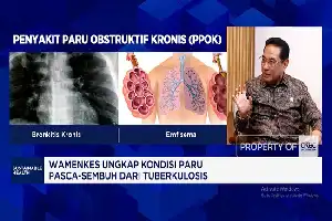 Kemenkes Perluas Skema Pelacakan TBC Nasional, Sasar 80 Ribu Desa