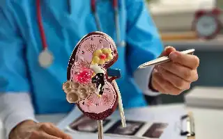 Kenali Faktor Risiko dan Gejala Awal Batu Ginjal yang Sering Diabaikan