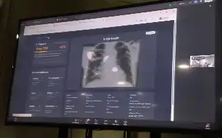 Akselerasi Eliminasi TBC, Kemenkes Integrasikan Teknologi AI untuk Deteksi Dini